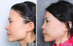 黄大勇做下颌角怎么样