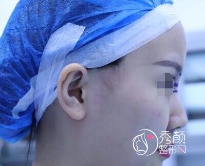 广州南方珠江医院陈伯华鼻修复怎么样|真实案例分享