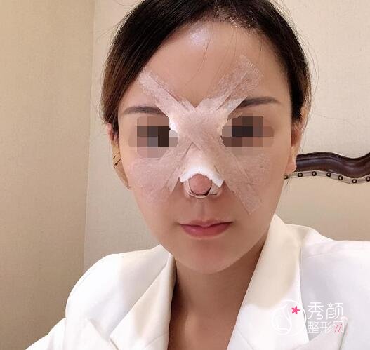 广州南方珠江医院陈伯华鼻修复怎么样|真实案例分享