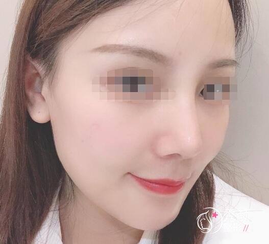 广州南方珠江医院陈伯华鼻修复怎么样|真实案例分享