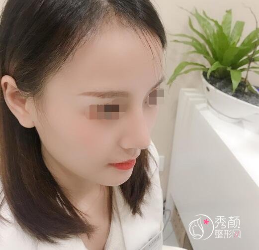 广州南方珠江医院陈伯华鼻修复怎么样|真实案例分享
