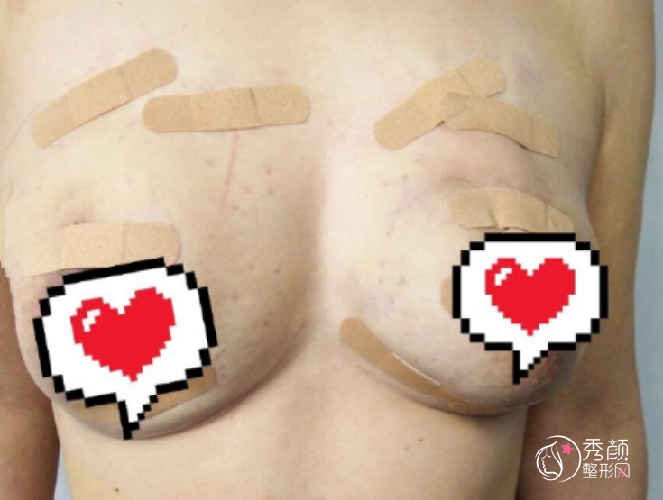 胸部下垂厉害,谁在韩啸做过乳房提升?