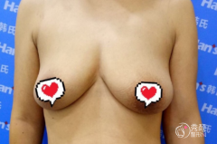 胸部下垂厉害,谁在韩啸做过乳房提升?