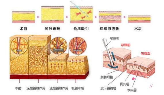 成都怡脂邓萌吸脂怎么样|附大腿吸脂案例