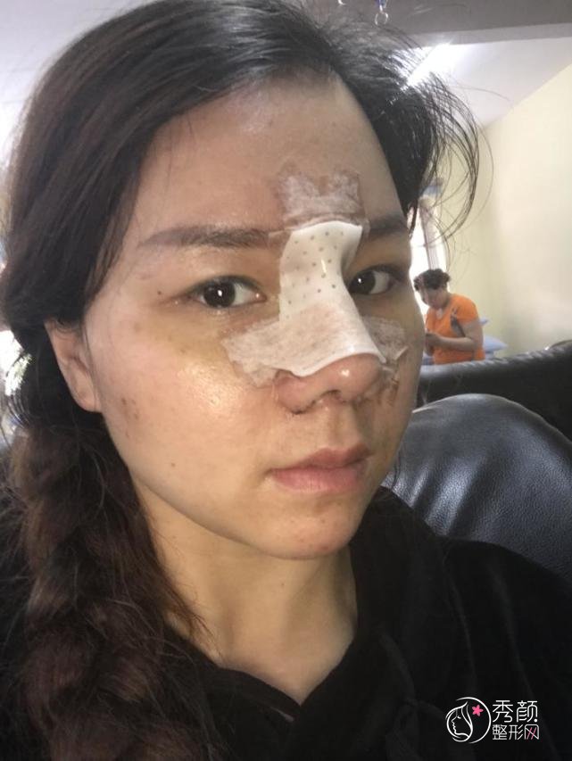 大连李荣喆修复鼻子怎么样|附鼻修复案例