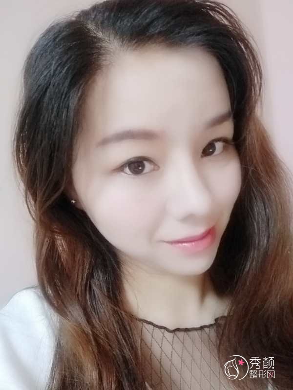 大连李荣喆修复鼻子怎么样|附鼻修复案例