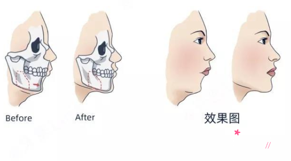 正颌手术费用一般是多少钱|正颌手术风险大不大