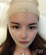 成都艾米丽程洪涛吸脂怎么样|附面部吸脂案例