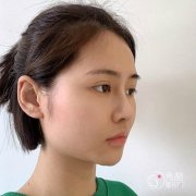 <b>李湘原鼻修复怎么样|上海伊莱美李湘原鼻修复案例曝光</b>