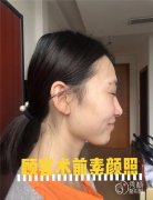 <b>刘先超磨骨怎么样|上海仁爱刘先超磨骨案例曝光</b>