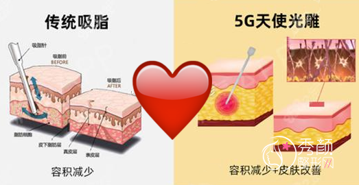 5g天使光雕吸脂术好吗| 5G天使光雕vs威塑吸脂哪个好