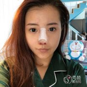 昆明华美美莱哪个医生做鼻子得好|果怎么样|附隆鼻案例