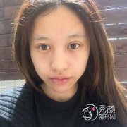<b>上海九院谢峰脂肪填充怎么样|附面部填充案例</b>