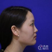 长沙华韩华美罗亮隆鼻怎么样|附隆鼻案例