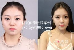 <b>上海华美何斌和上海伊莱美李旭东哪个吸脂好</b>