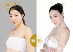 青岛诺德曹继武和华韩赵煜楠隆胸哪个好