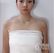 <b>上海伊莱美江华隆胸技术怎么样|附假体隆胸案例</b>