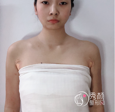 上海伊莱美江华隆胸技术怎么样|附假体隆胸案例
