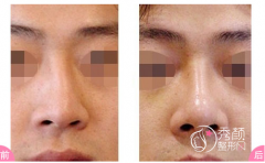 北京沃尔刘彦军、柏丽李劲良、喜美王会勇哪个做鼻修复较好