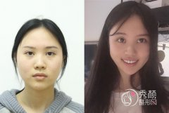 <b>上海华美何斌和张朋哪个吸脂好|附案例对比</b>