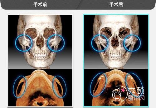 黄大勇磨骨做得怎么样|黄大勇颧骨内推、下颌角案例