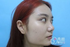 河南郑州赵绛波花了35600做的下颌角磨骨,就说值不值?【多图】