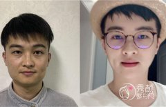 郑州大学第二附属医院李钢磨骨怎么样|附男士磨骨案例