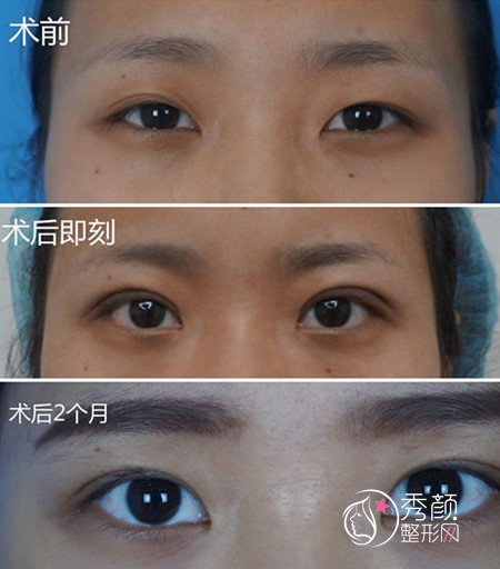上海华美张朋做双眼皮怎么样|附双眼皮案例对比