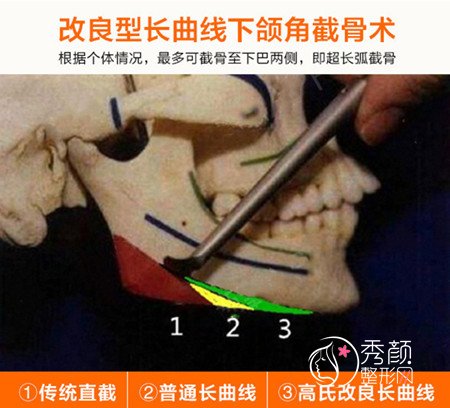 国内十大磨骨专家是谁_杭州高俊明磨骨怎么样