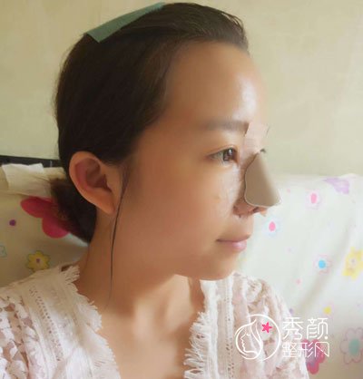 上海长征医院刘安堂鼻部手术做的好吗|附隆鼻案例果一览