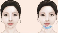 <b>北京八大处垫下巴多少钱,八大处垫下巴技术靠谱吗</b>