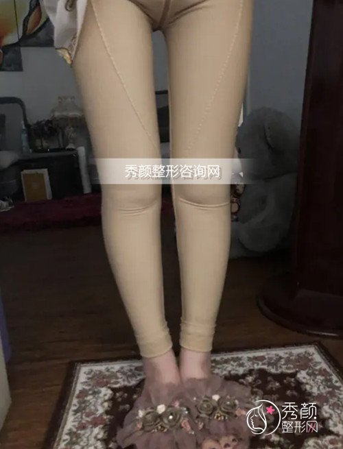 【直腿术】分享本人北京自体脂肪O型腿矫正拥有比直腿经历。