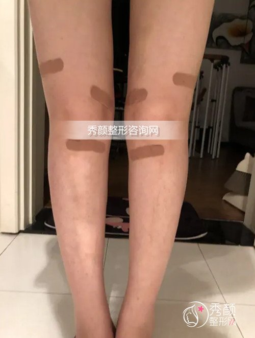 【直腿术】分享本人北京自体脂肪O型腿矫正拥有比直腿经历。