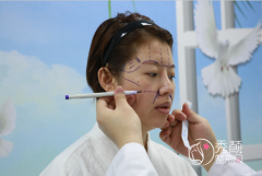 <b>曝光我在北京东方和谐做的自体脂肪全脸填充的经历。</b>