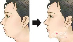 <b>九院垫下巴哪个医生好|九院垫下巴医生整理</b>