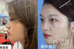 <b>广州隆鼻罗延平跟军哪个更厉害|附案例对比</b>