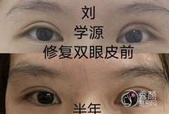 <b>青岛刘学源双眼皮修复案例</b>