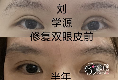 青岛刘学源双眼皮修复案例