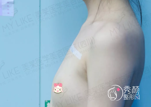 四川美莱吴江山隆胸怎么样|附隆胸案例