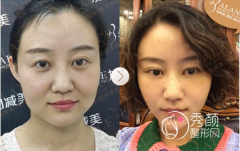 <b>北京加减美穆宝安做v美减龄面部提升手术技术怎么样</b>