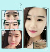 <b>田国静修复双眼皮怎么样|田国静修复双眼皮案例</b>