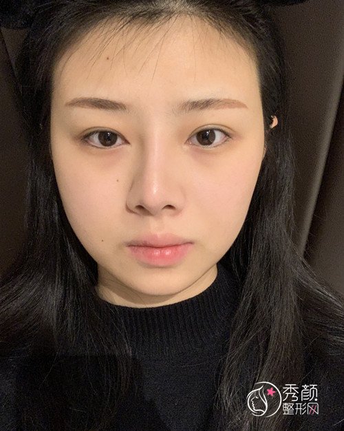 上海华美李健肋软骨隆鼻修复案例,10万的鼻子大家觉得值吗?