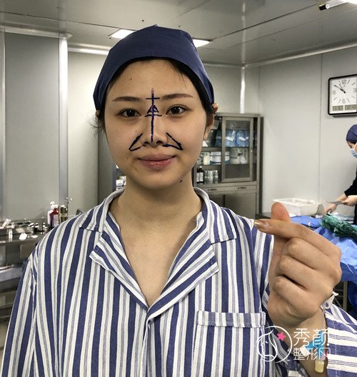 上海华美李健肋软骨隆鼻修复案例,10万的鼻子大家觉得值吗?