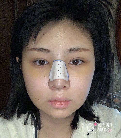 上海华美李健肋软骨隆鼻修复案例，10万的鼻子大家觉得值吗?
