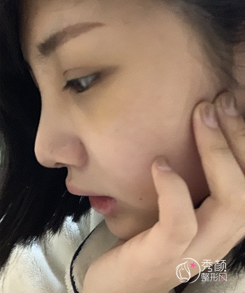 上海华美李健肋软骨隆鼻修复案例,10万的鼻子大家觉得值吗?