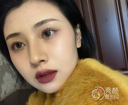 上海华美李健肋软骨隆鼻修复案例，10万的鼻子大家觉得值吗?