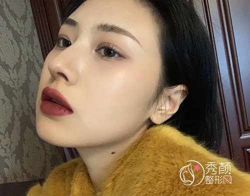 上海华美李健肋软骨隆鼻修复案例,10万的鼻子大家觉得值吗?