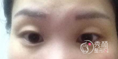 <b>上海九院苏薇洁双眼皮案例图</b>
