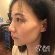 <b>上海九院谢芸脂肪填充怎么样|附面部填充案例</b>