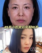 <b>北京加减美v美减龄和东方瑞丽pst面部提升,哪个除皱果比较好</b>